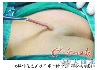 女?huà)氲奈舶驼谑中g(shù)切除中