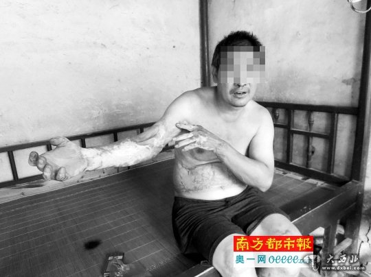 去年6月，為阻止女兒和一男子約會，氣頭上的李春生忘了關煤氣閥門，全身被燒燙傷68%。